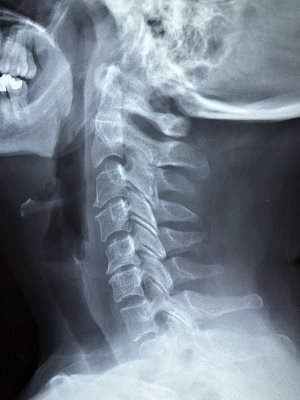 Dekalb Illinois x-ray of man's neck